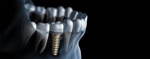Different types of dental implants