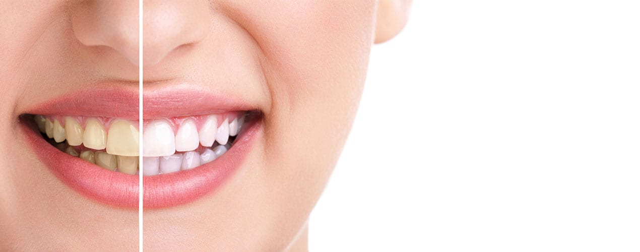 teeth whitening