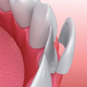 veneers