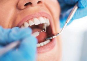 Dental Fillings