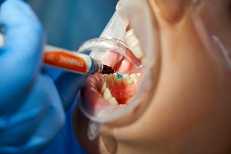 Dental Filling Costs and Insurance Coverage
