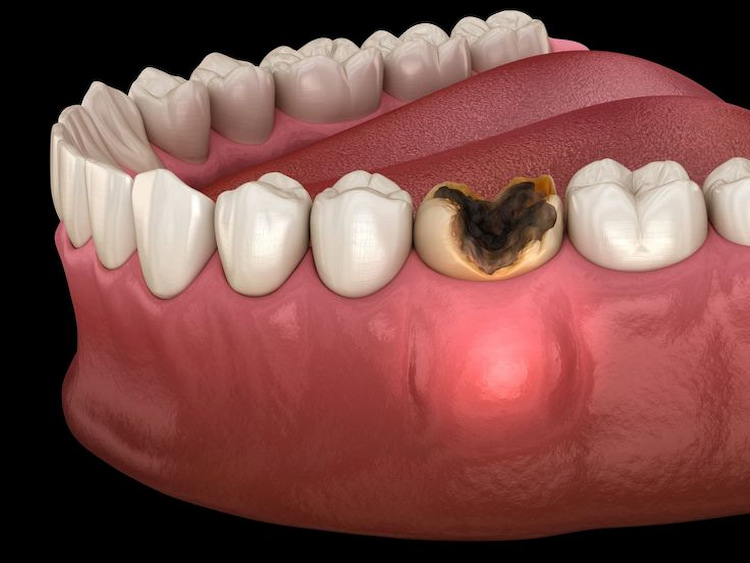 Preventing tooth decay