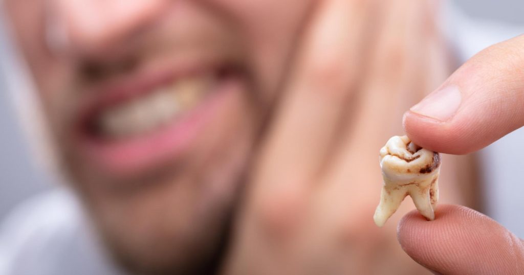 Preventing Tooth Decay