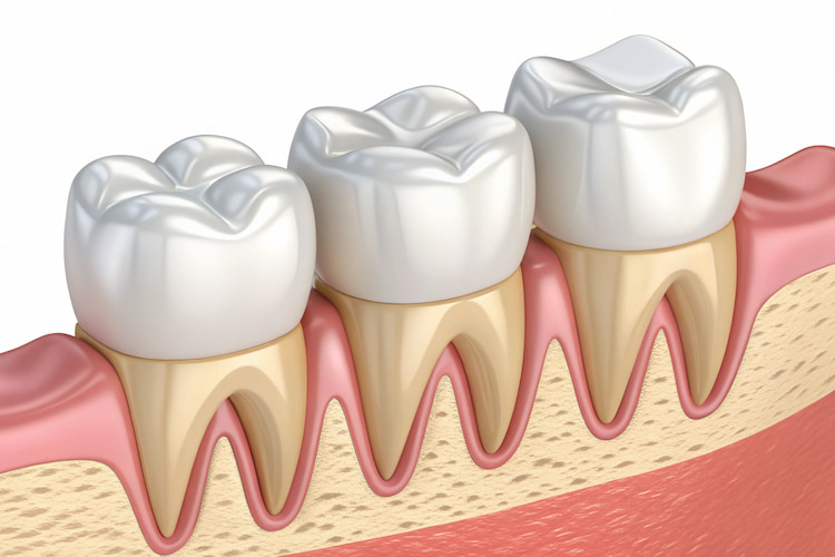 Aesthetic Benefits of dental crowns