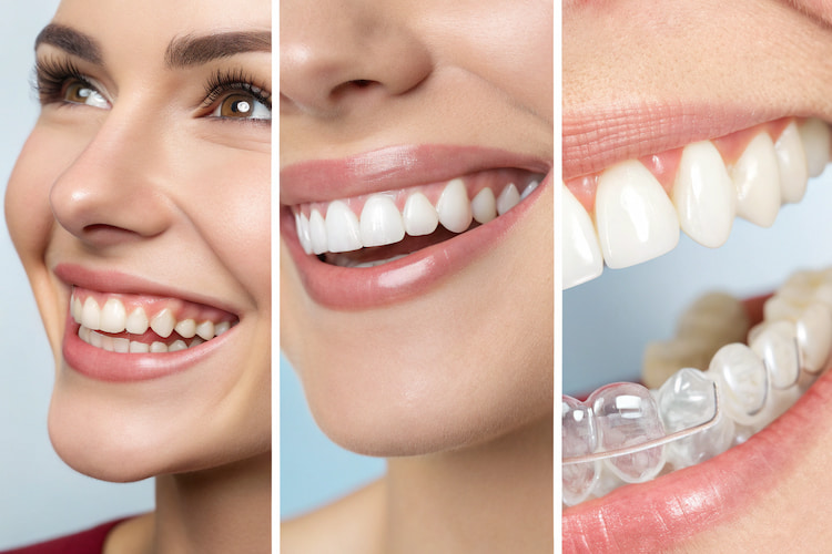 Popular Alternatives to Dental Veneers