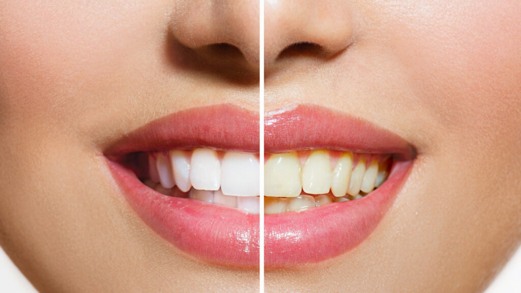 Teeth Whitening Before and After in North York