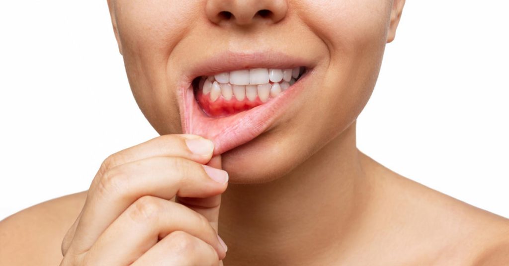 bleeding gums