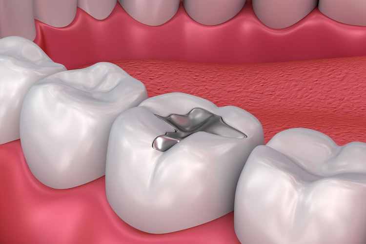 Silver Fillings (Amalgam)