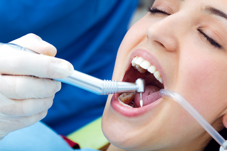 Dental Filling in Toronto and Thornhill