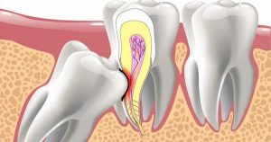Impacted Wisdom Tooth