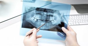 Risks of Not Removing Wisdom Teeth