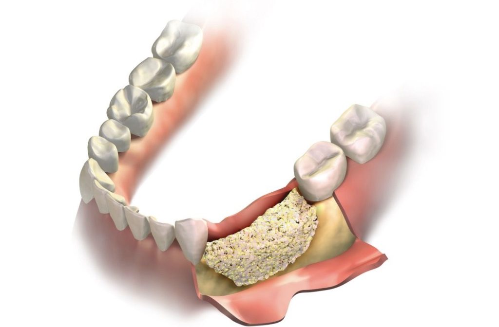 Bone graft for bone loss due to tooth loss or gum disease