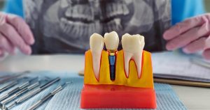 What Is Bone Grafting and Why Is It Needed?