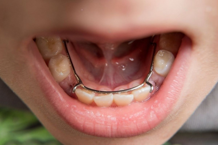 a space maintainer, a small device that holds the space until the permanent tooth is ready after baby teeth falling out 