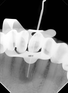 Infected tooth before oral surgery at our North York clinic, and Healing progress nine months after oral surgery, and Fully restored tooth after oral surgery in North York.
