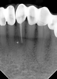 Infected tooth before oral surgery at our North York clinic, and Healing progress nine months after oral surgery, and Fully restored tooth after oral surgery in North York.