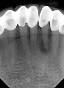 Infected tooth before oral surgery at our North York clinic, and Healing progress nine months after oral surgery, and Fully restored tooth after oral surgery in North York.