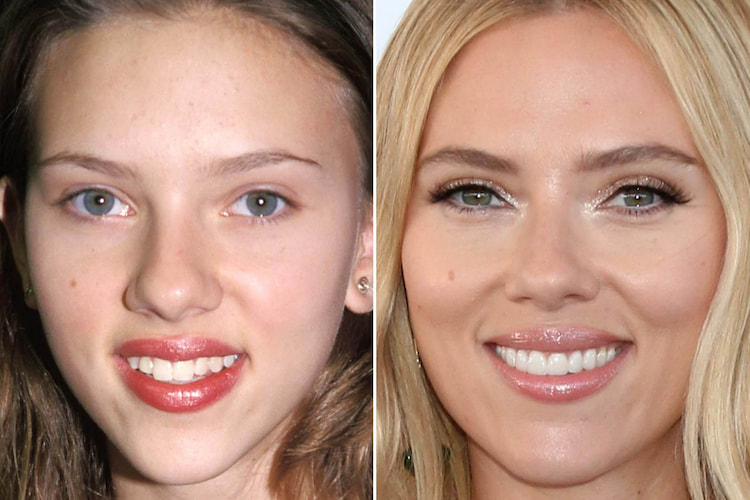 a photo of a famous person before and after having dental veneers showing how long veneers last 