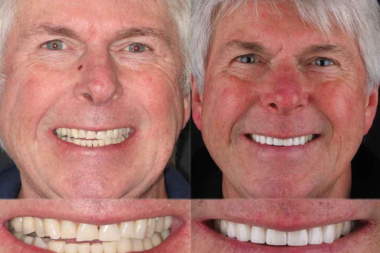 a photo showing a before and after transformation of veneers for older adults 