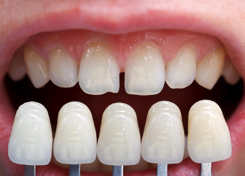 too white dental veneers
