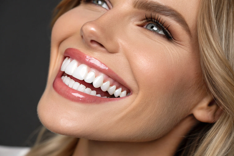 a photo of a woman with well-crafted natural dental veneers