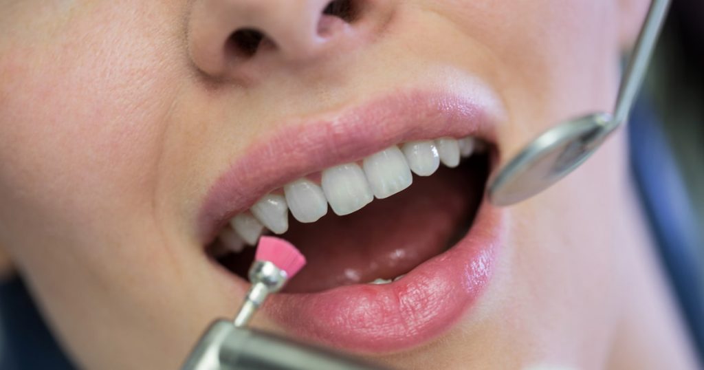 a photo showing how a chipped veneer replacement works