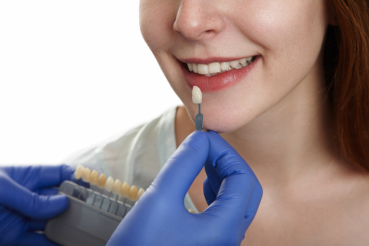 a photo of a dentist choosing veneer shades to replace a chipped veneer