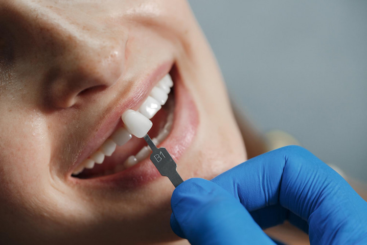 a photo showing a dentist fixing a chipped veneer