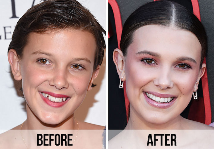 a photo of a celebrity before and after having veneers 
