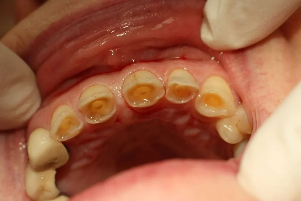 before veneers checkup: teeth worn to dentin