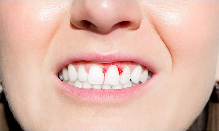 a photo of a person showing bleeding gums