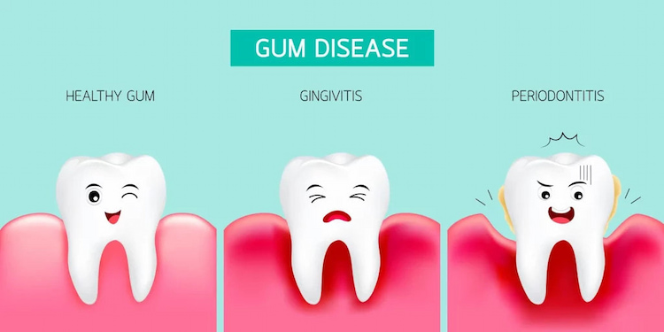 a photo of dental bleeding gums stages and periodontitis