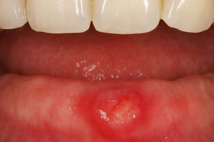 a photo showing early stage denture sores 