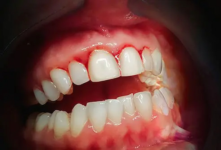 a photo showing what bleeding gums look like