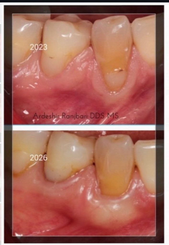 Oral Surgery by Dr. Ranjbari — 3 Years Later