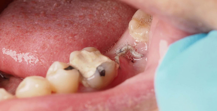 a photo of infection after tooth extraction to show why antibiotics after tooth extraction are necessary