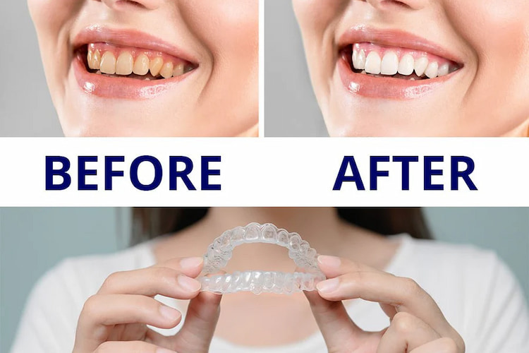 a photo showing the before and after of using trays for teeth whitening for smokers 