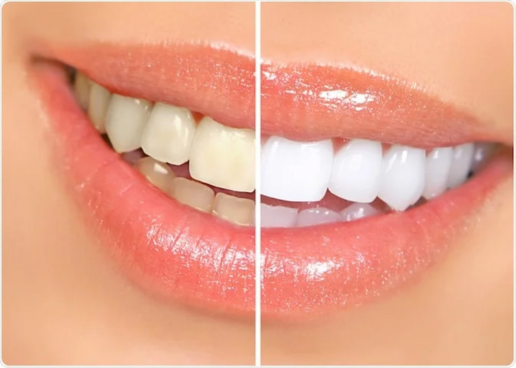 professional teeth whitening treatment results vs. top whitening toothpastes