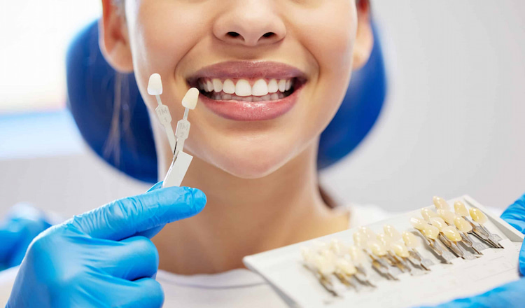 alternatives to dental veneers 