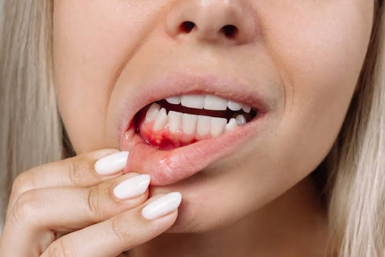 a photo of a woman showing veneers hiding gum recession