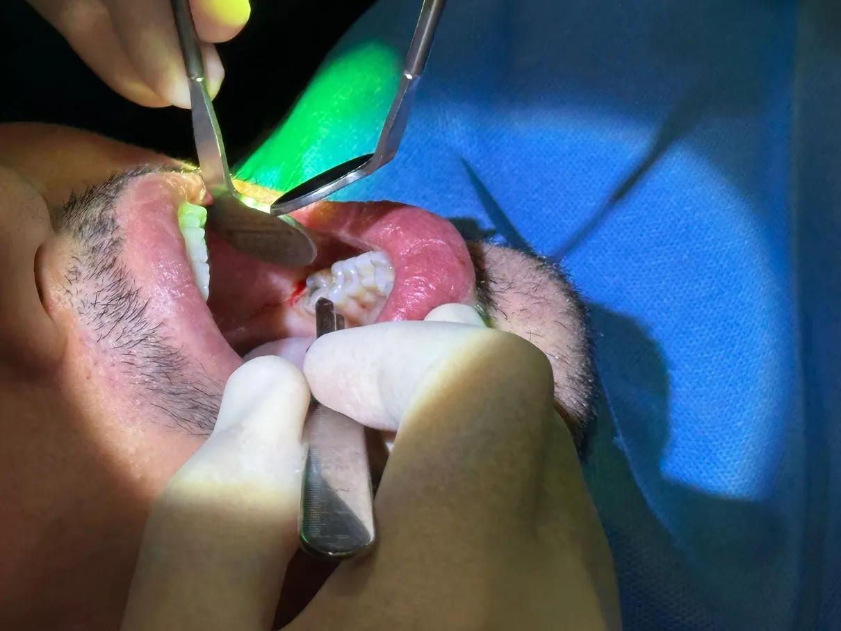 What to Expect During Your Tooth Extraction Procedure
