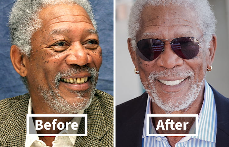 a photo showing dental veneers before and after and why veneers fail after 10 years 
