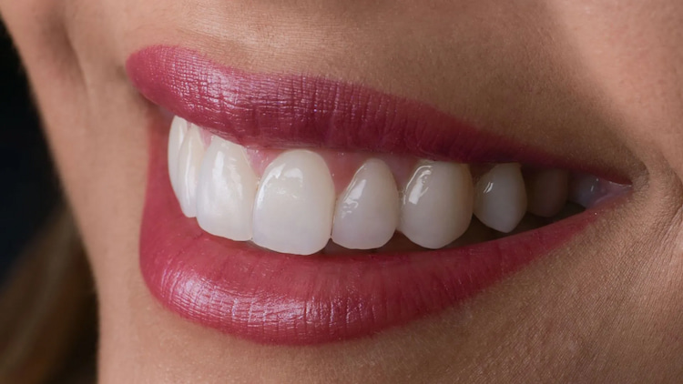 a close up photo of dental veneers indicating what you can eat after veneers 