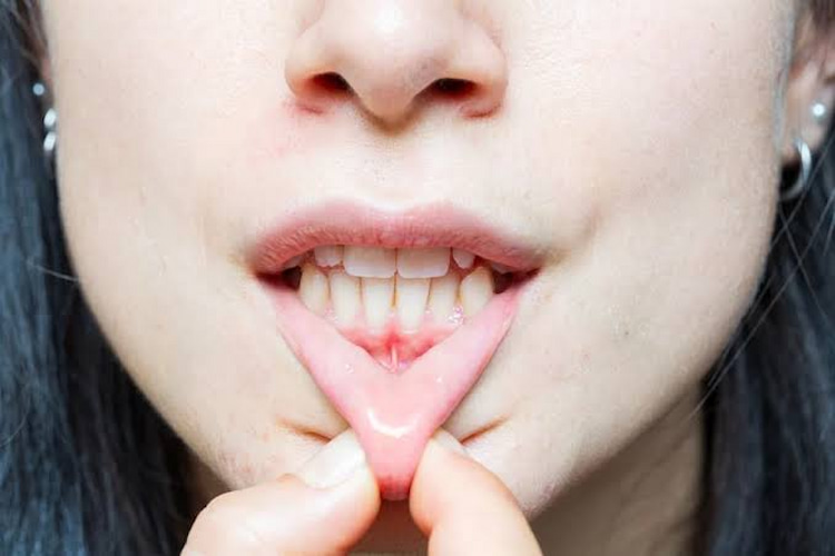 a photo showing severe gum recession 
