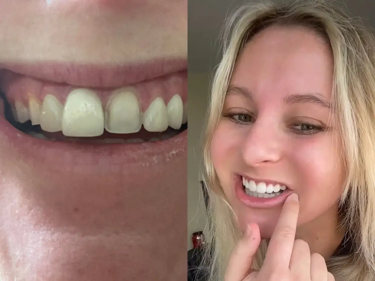 a photo of a woman showing her veneers fail 