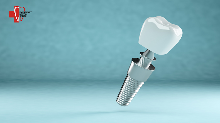 a photo of a dental implant and showing how dental implant surgery works 