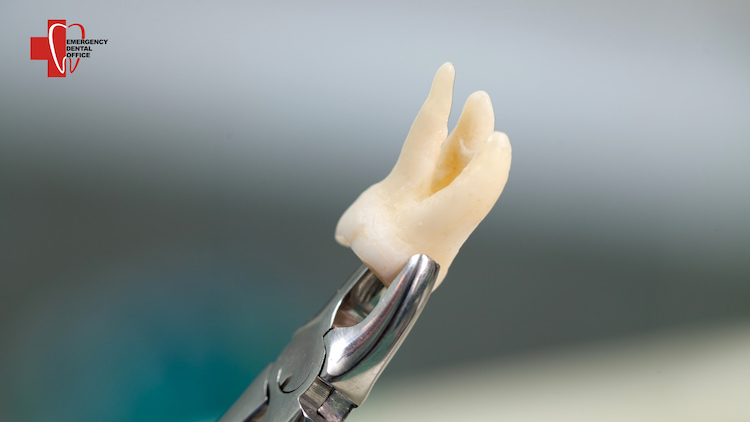 a photo of emergency tooth extraction to remove tooth infection signs 