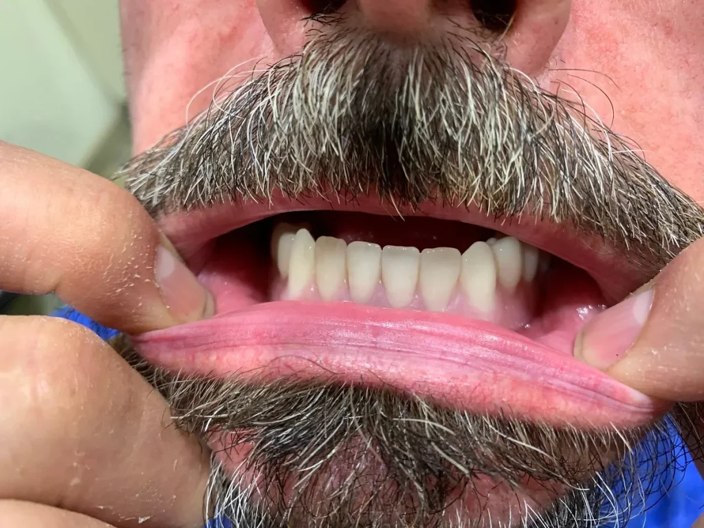Real Patient Evidence Dental Implant after