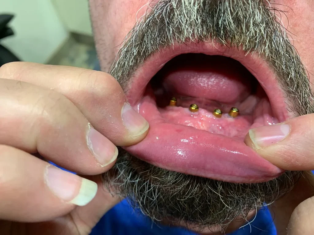 Real Patient Evidence Dental Implant before