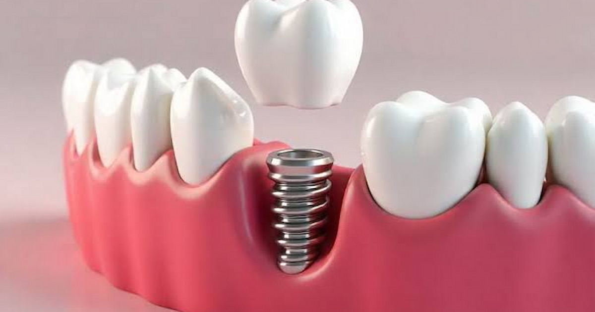 a photo of dental implant surgery complications